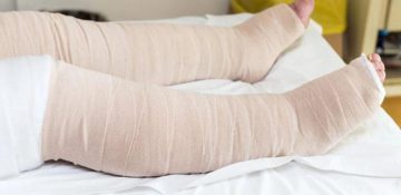 Lenfödem (Cerrahi Komplikasyon Postmastekdomi) FİZİK TEDAVİ İSTANBUL 3 Lenfödem (Cerrahi Komplikasyon Postmastekdomi)