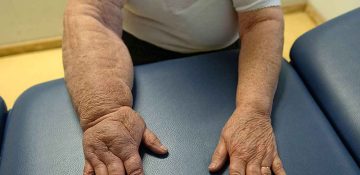 Herediter Lenfödem Nedir FİZİK TEDAVİ İSTANBUL 4 Herediter Lenfödem Nedir