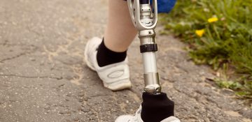 Ayağın Ayak Bileği Düzeyinde Travmatik Amputasyon FİZİK TEDAVİ İSTANBUL 1 Ayağın Ayak Bileği Düzeyinde Travmatik Amputasyon