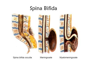 SpinaBifidaSpinabifidaoccultaMeningoceleMyelomeningocele Spina Bifida ve Egzersiz