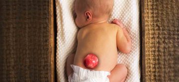 timthumb Spina Bifida Tedavisinde Fizyoterapinin Yeri