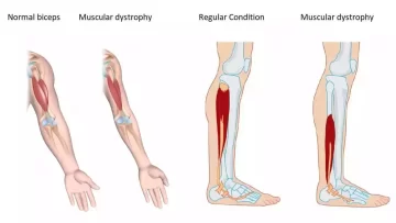 DMD Hastalığında Fizik Tedavi ve Süreç FİZİK TEDAVİ İSTANBUL duchenne muskuler distrofi hastaliginda kaslarin gorunumu jpg bREG DMD Hastalığında Fizik Tedavi ve Süreç