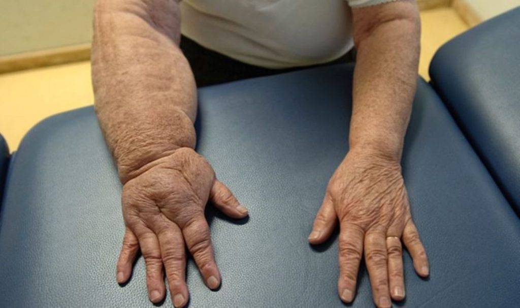 Lenfödem Tehlikeli midir?