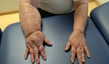 kapak 140004 Lenfödem Tehlikeli midir?