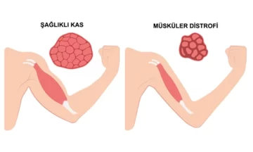 muskuler distrofi MÜSKÜLER DİSTROFİ VE FİZİK TEDAVİ