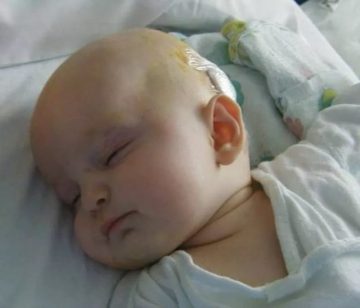 simptomy i lechenie gidrocefalnogo sindroma u grudnichka2 Hidrosefalinin Fizik Tedavi ile Tedavisi