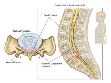 342 320617 Kauda Equina Sendromu ve Fizik Tedavi 