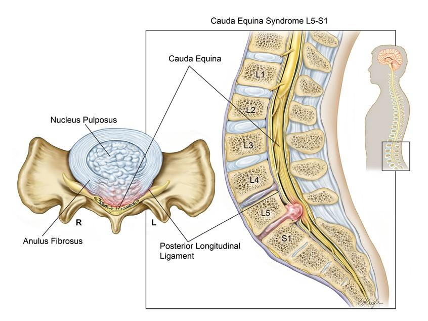 Kauda Equina Sendromu ve Fizik Tedavi 