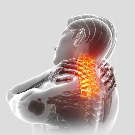 Boyun Fıtığına Ne İyi Gelir FİZİK TEDAVİ İSTANBUL 70452291 3d illustration of men feeling the neck pain Boyun Fıtığına Ne İyi Gelir