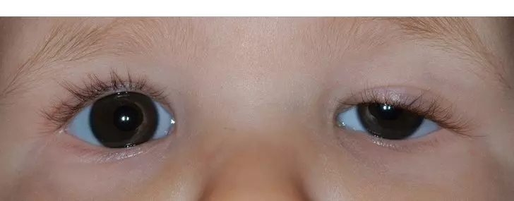 Konjenital Miyopatide Fizik Tedavinin Rolü FİZİK TEDAVİ İSTANBUL Konjenital Miyopatide Fizik Tedavinin Rolü