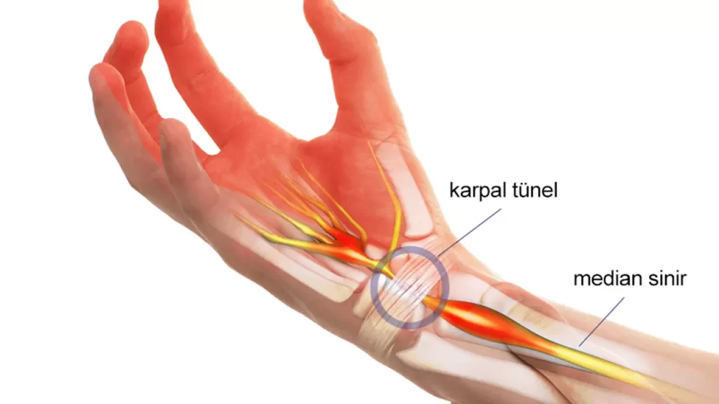 Karpal Tünel Sendromu Ve Fizyoterapi FİZİK TEDAVİ İSTANBUL XV4xl 1685441902 8374 Karpal Tünel Sendromu Ve Fizyoterapi