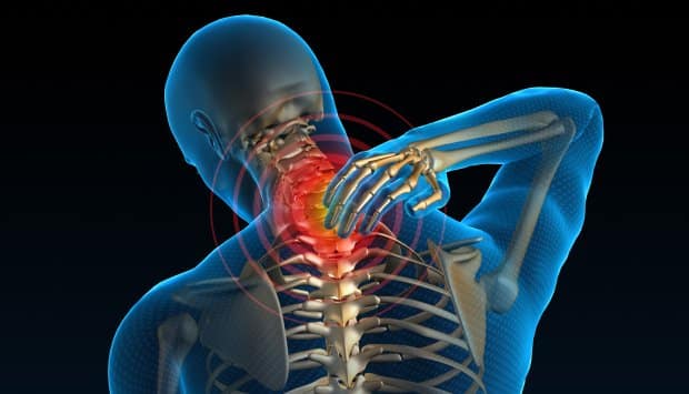 Boyun Fıtığına Ne İyi Gelir FİZİK TEDAVİ İSTANBUL radiculitis Boyun Fıtığına Ne İyi Gelir