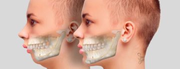 ortognatik ic 1 1024x394 1 Çene Rehabilitasyonu Nedir?