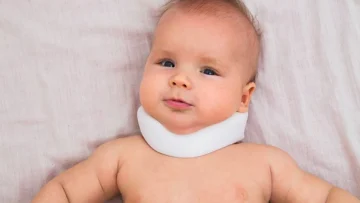 Tortikolis Erken Yaşta Rehabilitasyonun Önemi: Çocuklarda Gelişimsel Destek