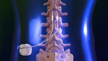 agri pili 95Hw Omurilik Pili ve Parapleji’de Kullanımı