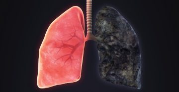 amfizem nedir 871142 Amfizem Hastalarında Fizik Tedavi Yöntemleri