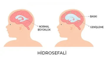 hidrosefali nedir belirtileri ve tedavi yontemleri nelerdir 2 Hidrosefali Hastalarında Robotik Fizik Tedavi