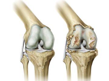 robotik rehabilitasyon merkezi osteoartrit kadinlarda daha mi sik gorulur px5eoyiOSM Osteoartrit Hastalarında Fizik Tedavi Ne Kadar Etkili?